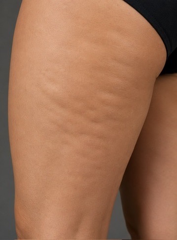 Before Red Light Therapy — cellulite