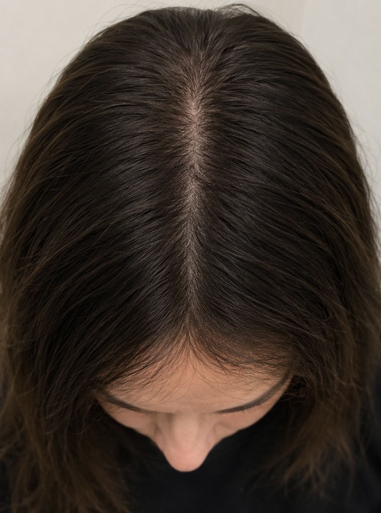 After Red Light Therapy — fuller, thicker hair