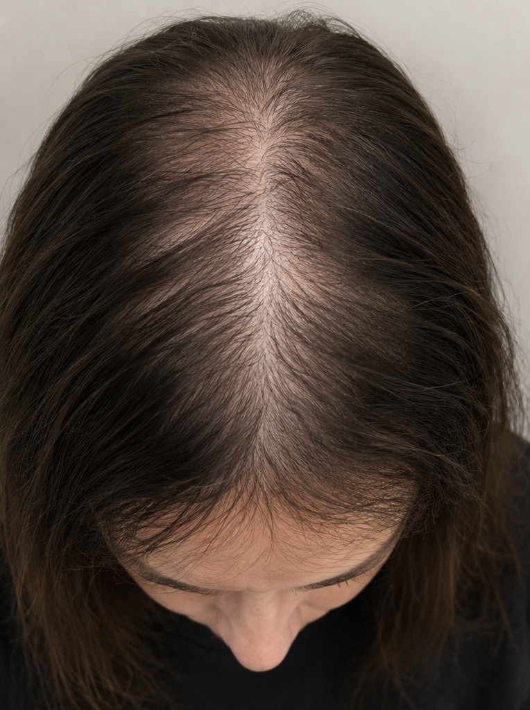 Before Red Light Therapy — thinning hair